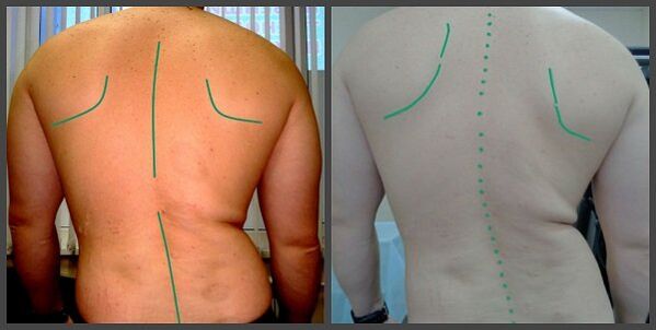 انحناء العمود الفقري مع العظم