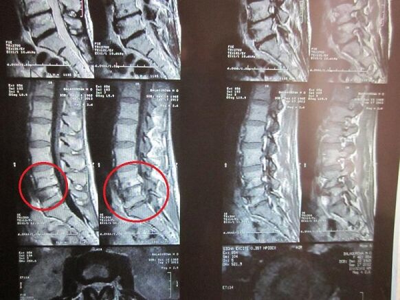 تشخيص التهاب العظم العنقي