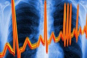 عدم انتظام ضربات القلب من أجل التهاب العظم