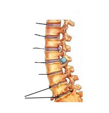كيف يتطور هشاشة العظم