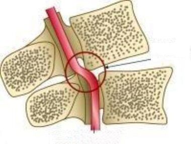 متلازمة الشريان فيل