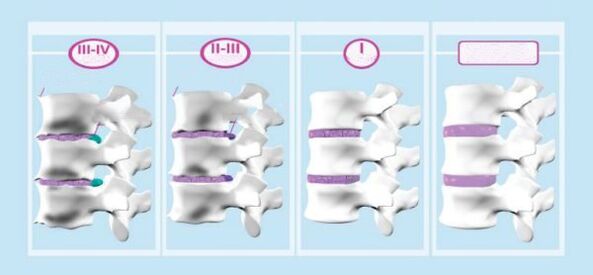 مراحل التسمم العظمي العنقي