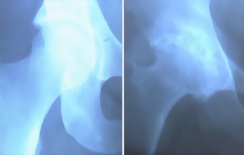 حثالة على المفصل في الركبة