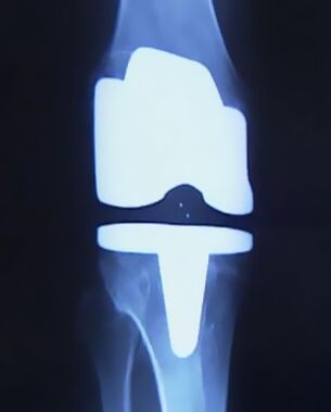 صورة X -ray للركبة مع الاصطناعية الاصطناعية بعد العملية لتغيير المفصل