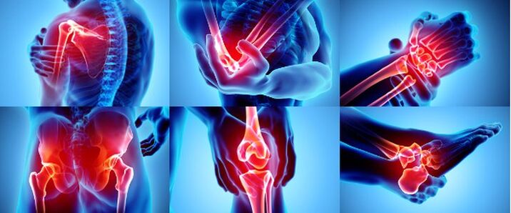 المفاصل الملتهبة