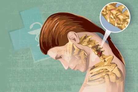 أعراض رد الفعل من هشاشة العظم